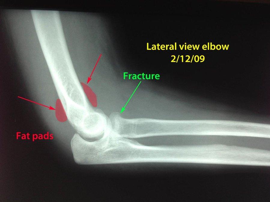 Fig 3: A subtle fracture of the head of the radius bone in the forearm is present (green arrow).