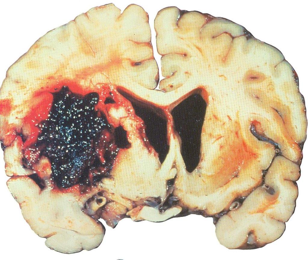 Smoking decreases the blood supply to your brain vessels This brain shows