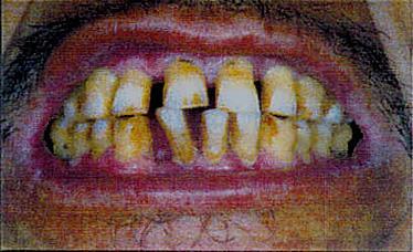 teeth Gum inflammation Black