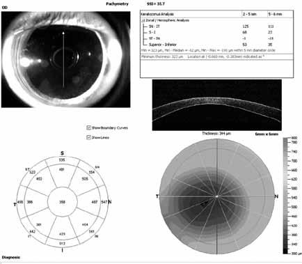 Kerala Journal of Ophthalmology Vol. XXII, No.2, June 2010 uncooperative adults. Since the procedure can be performed in a sitting position, we can study angle dynamics in physiological position.