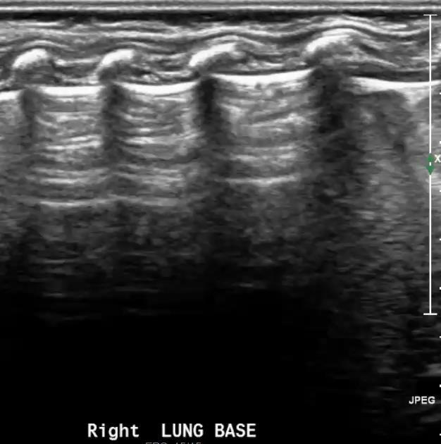 pneumonia A lines: Echogenic, horizontal, usually evenly spaced lines parallel to the pleural interface Reverberation artifacts created by repetitive reflection of the US