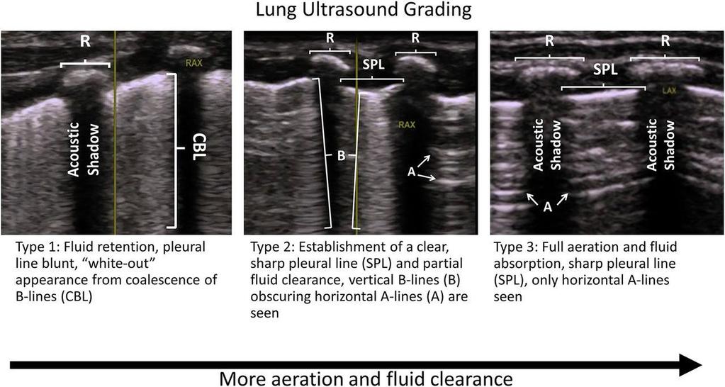 Grading system for lung ultrasound from Raimondi et al.