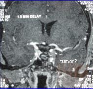 Postoperative MRI Substantial tumor debulking was achieved There is no longer any