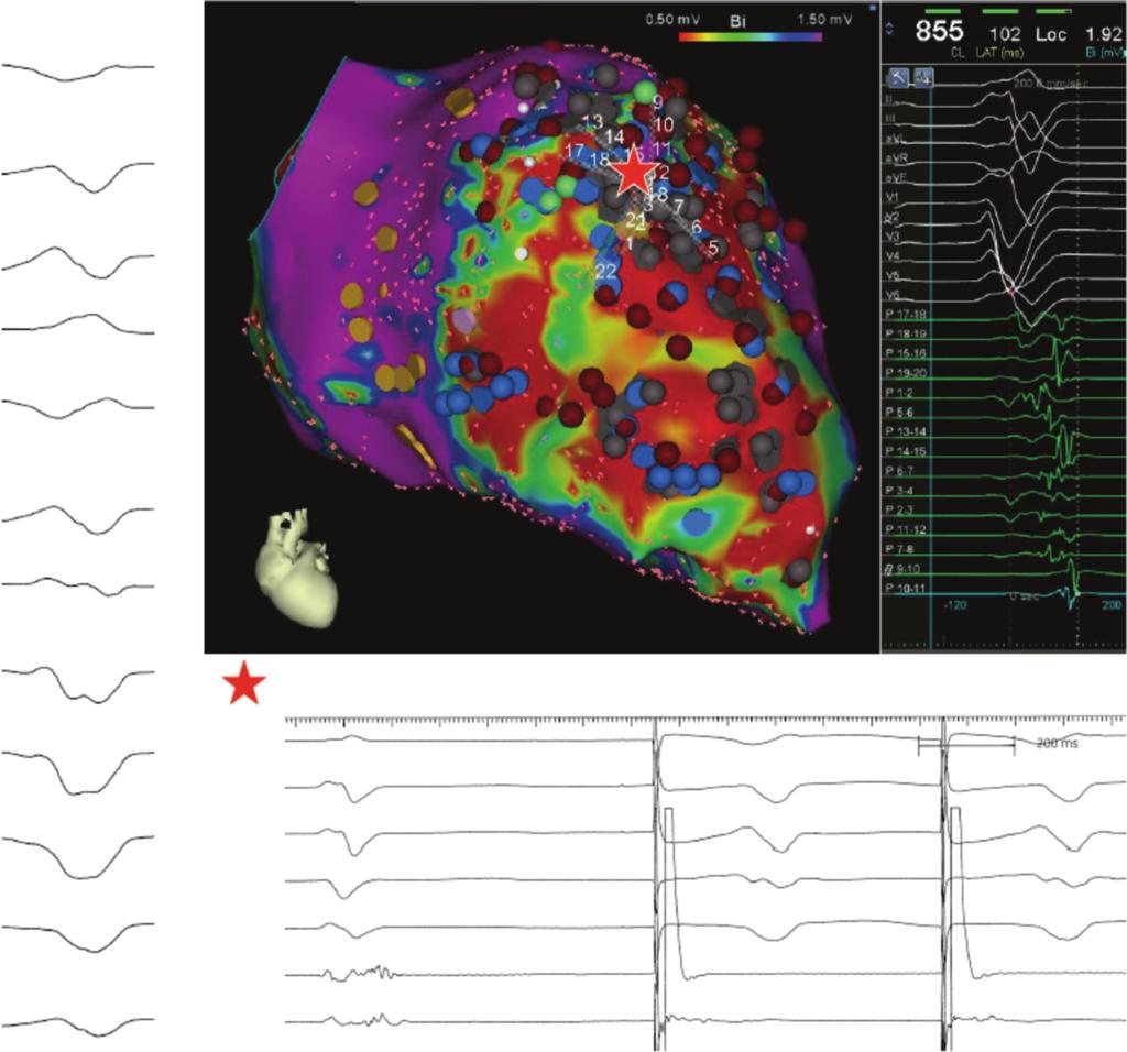 Ablation of ischemic ventricular tachycardia Baldinger et al. Clinical VT I II III avr avl avf V1 V2 Pace-mapping within the scar I V3 II III V4 V1 V5 V5 AbI prox V6 AbI dist FIGURE 1.