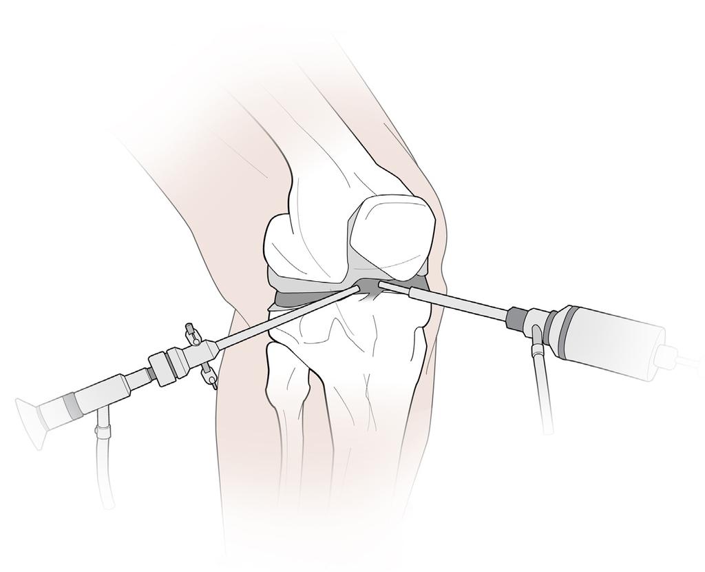 What is a knee arthroscopy? Knee arthroscopy surgery lets your surgeon look inside your knee joint and maybe repair the problem found during the surgery.