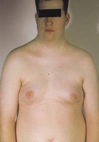 Klinefelter syndrome 47, XXY Maternal or paternal