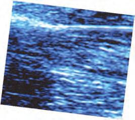 In addition to being invaluable for pretreatment assessment, ultrasound is used for guidance during endovenous ablation and for follow-up exams.