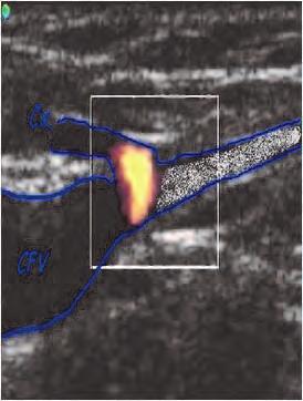 The Role of Ultrasound in Endovenous Ablation There are two main techniques used for endovenous ablation both result in a non-thrombotic vein occlusion by heating of the vein wall.