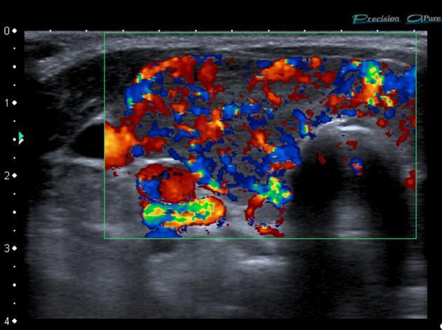 Graves-Basedow disease -> Thyroid inferno pattern
