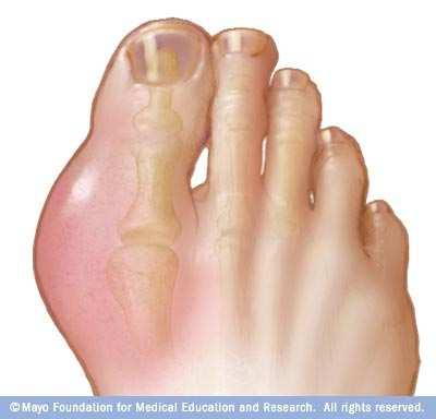 Got Gout? Get a Plumber. Heidi Garcia, PA-C Department of Rheumatology Division of Internal Medicine Mayo Clinic Arizona 2013 MFMER slide-1 Objectives Recall some of the history of Gout.