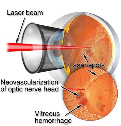 A person with retinal abnormalities may undergo a procedure called photocoagulation, in which a laser or xenon arc light is used to cause condensation of protein material in the eye.