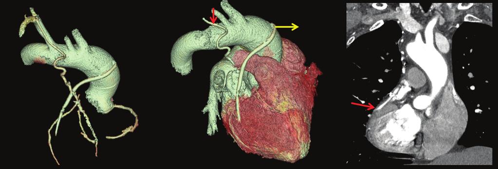 378 SECTION V Cardiac Imaging RIMA GRAFT RSVG GRAFT RCA LAD A B C Figure 45-3. A 55-year-old man (known case of CAD) presented with atypical chest pain since 1 month.