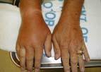 Acute gouty flares Abrupt onset of severe joint inflammation, often nocturnal Warmth, swelling, erythema, & pain; possibly fever Untreated?