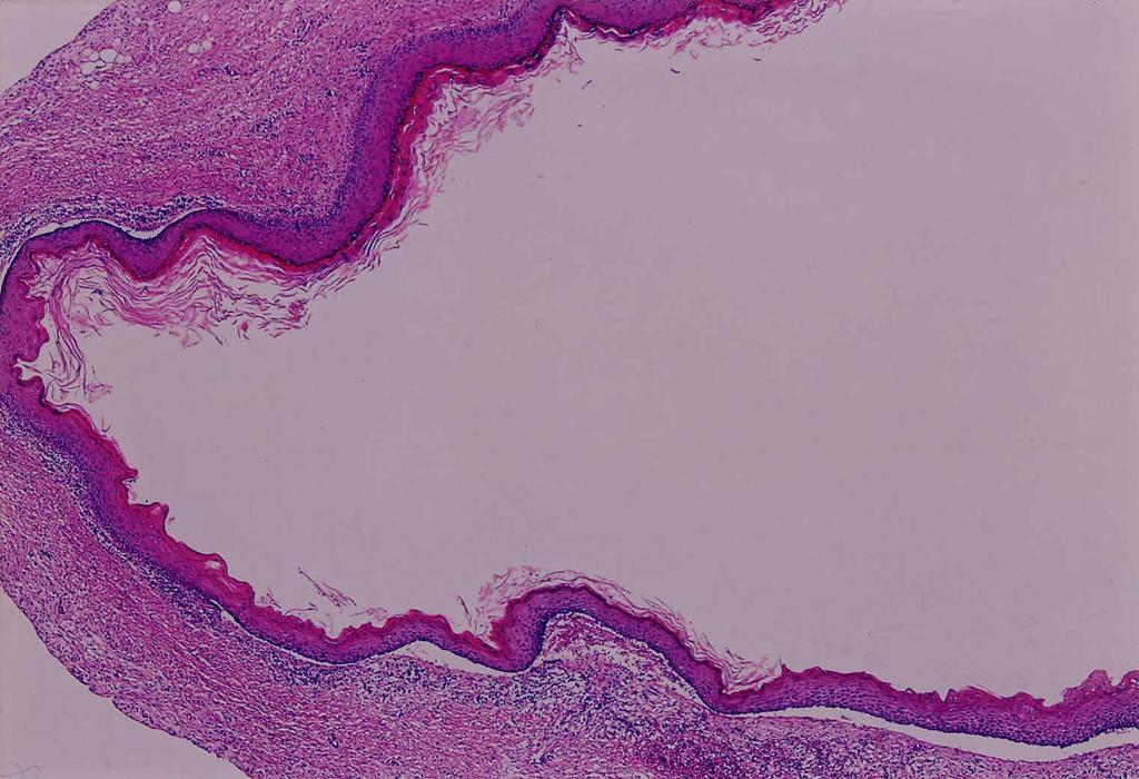 Odontogenic Carcinoma of Mandible 161 Fig. 7 Low power view of the thin orthokeratinized epithelium of the cyst wall and the corrugated appearance of the inner cystic surface.