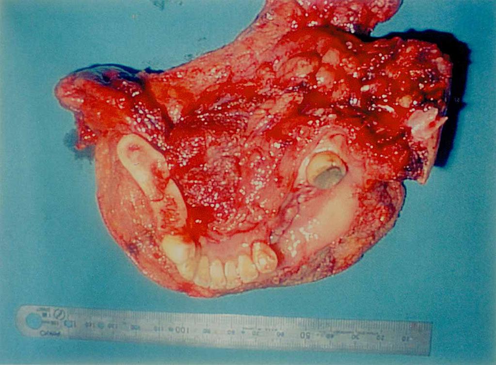 Part of the tumor was arranged in an odontogenic pattern, with basal-type cells forming alveoli.