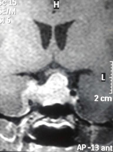Bilateral Internal Carotid Artery Is Lateral Displaced.