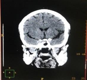 There Was No Csf Leak Postoperatively At 2 Weeks Of Surgery, Repeat Brain Mri Was
