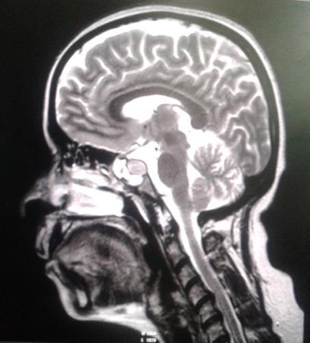 At 1 Month Of Surgery, Both Mother And Baby Are Living A Healthy Life With No Neurological Deficit Post-Operative Mri Scan- Changes Are Seen In Sphenoid Sinuses At T2w/Flair Mixed Signal Intensities.