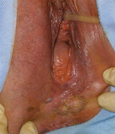 Warty lesion Hyperpigmented periphery,