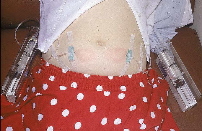 Subcutaneous Ig therapy in