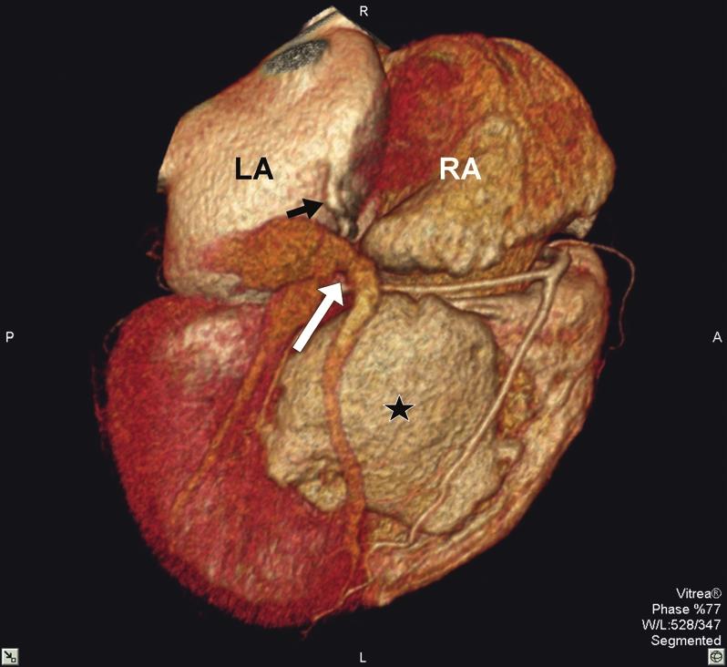 Congenital Coronary Sinus Anomaly at MDCT and regression of the three major paired venous systems.