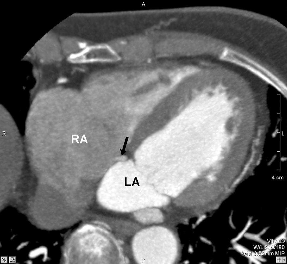 The rare type of absence of the coronary sinus (Fig.