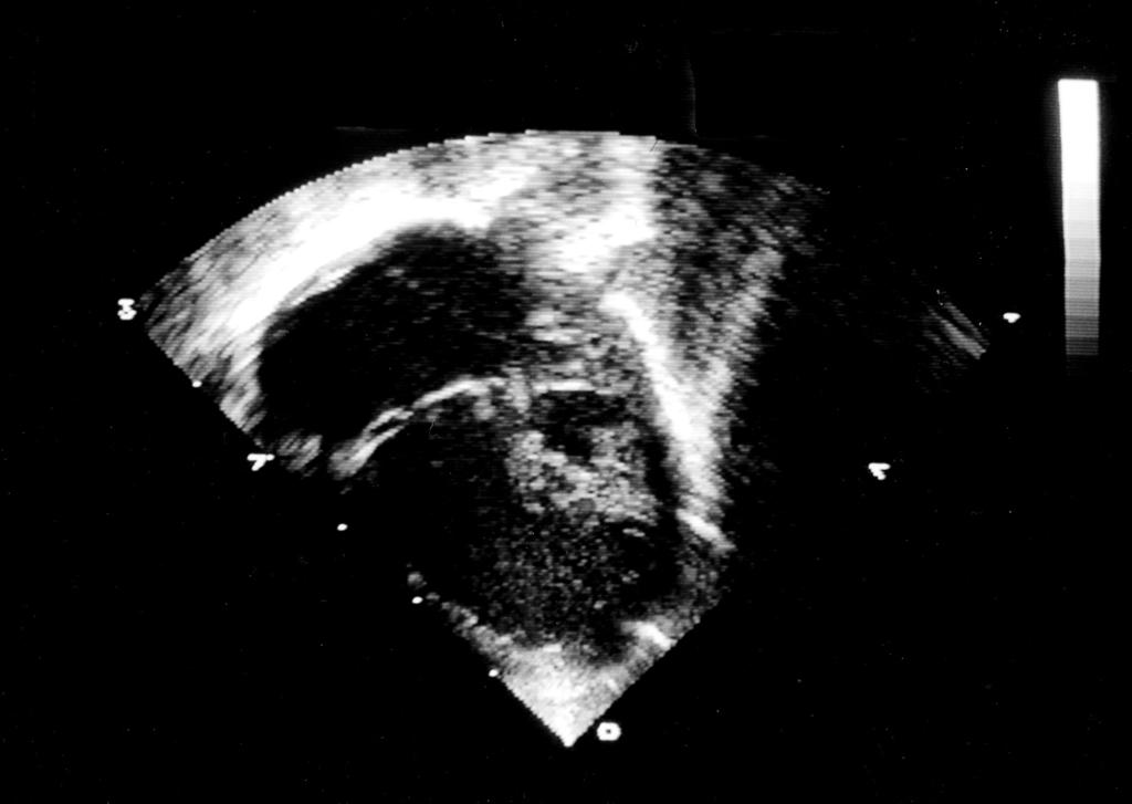 ECHOCARDIOGRAPHY IN Figure 44-7 Hypoplastic Left Heart