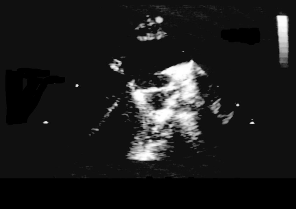 ECHOCARDIOGRAPHY IN Figure 44-8 Truncus Arteriosus Aorta