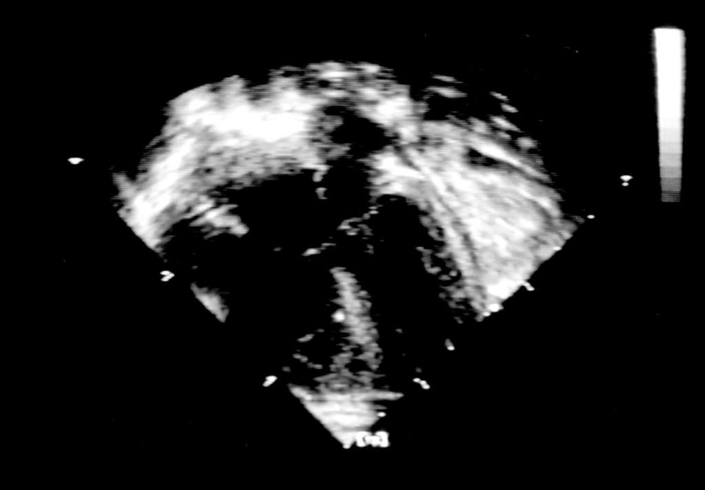 ECHOCARDIOGRAPHY IN Figure 44-3 Atrioventricular Septal Defect Left atrium Right atrium