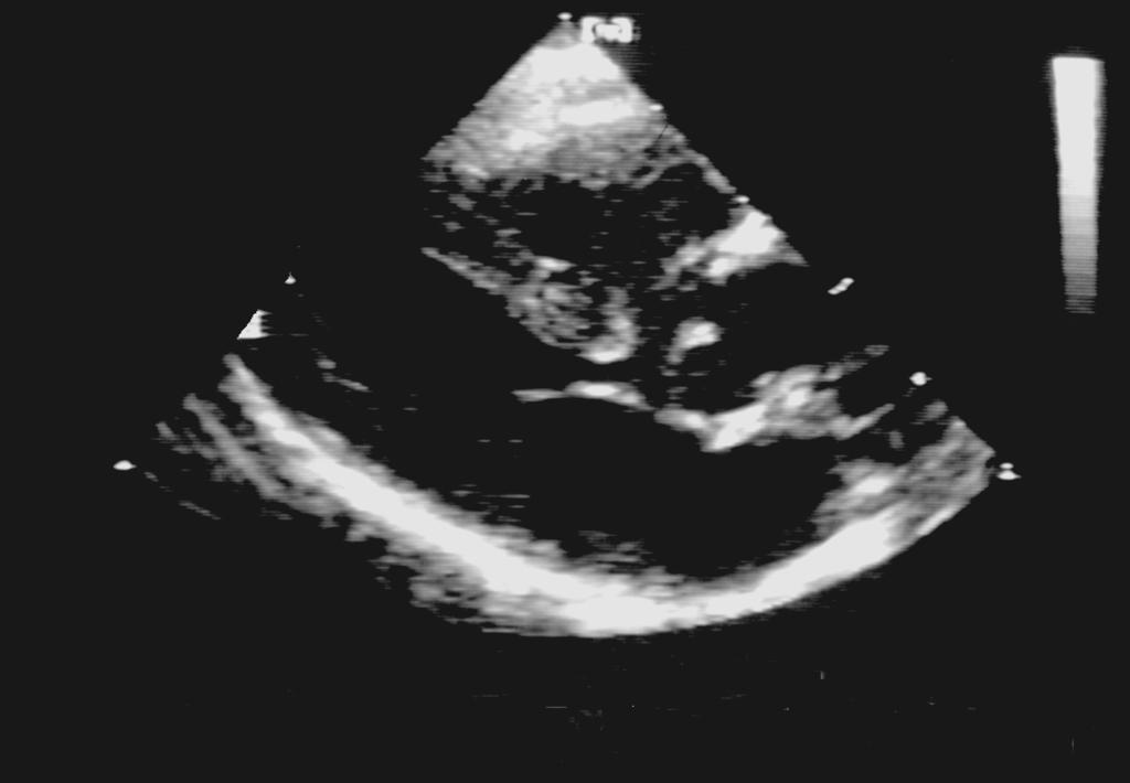 ECHOCARDIOGRAPHY IN Figure 44-5 Tetralogy of Fallot Right ventricle