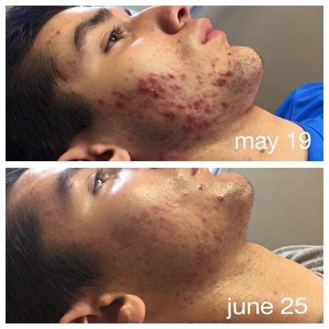 Before & After Before Celluma 5 weeks