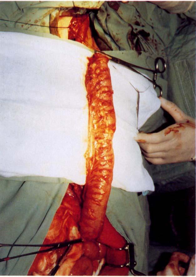 66 HUANG ET AL Ann Thorac Surg 989;48:66-4 tasis, and received only palliative colon bypass with the technique just described. The other 37 patients underwent initial exploratory thoracotomy.