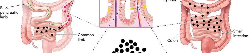 See Appendix B for more information Dumping Syndrome Early (10 60 min) Bloating Sweating Dizziness Flushing Painful