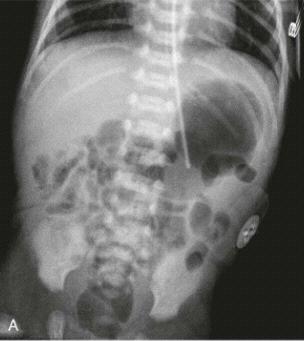 Malrotation with volvolus - Imaging Plain abdominal radiograph: Bowel distention Lack of bowel gas distal to stomach Markedly dilated 2 day old infant with bilious vomiting stomach Separation of