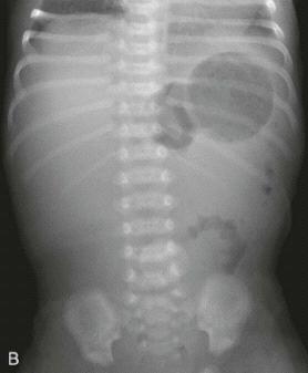 Malrotation with volvolus - Imaging Plain abdominal radiograph: Bowel distention 7 day old infant with bilous vomiting Lack of bowel gas distal to stomach Markedly dilated stomach Separation of