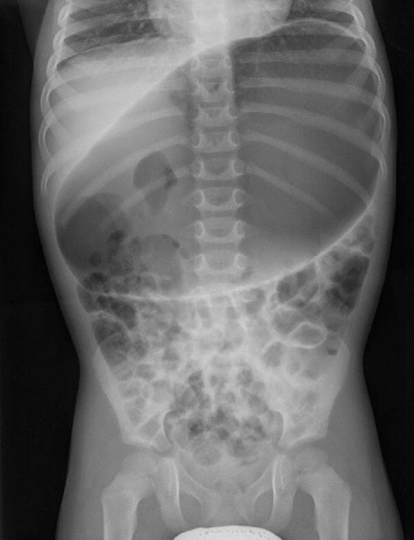 Malrotation with volvolus - Imaging Plain abdominal radiograph: Bowel distention Lack of bowel gas distal to stomach Markedly dilated stomach Separation of