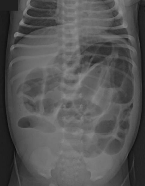 Malrotation with volvolus - Imaging Plain abdominal radiograph: Bowel distention Lack of bowel gas distal 2 week old infant with bilous vomiting for several days to stomach Markedly dilated stomach