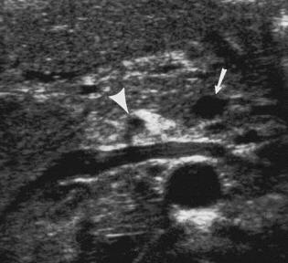 Malrotation with volvolus - Imaging Ultrasound Inversion of the SMA and SMV Duodenal wall thickening (>2mm) Dilated distal SMV