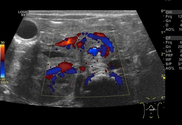 Malrotation with volvolus - Imaging Ultrasound Inversion of the SMA and SMV Duodenal wall thickening (>2mm)
