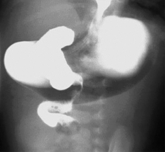 Malrotation with volvolus Imaging Upper GI series Infant with malrotation with volvolus Incomplete obstruction of duodenum