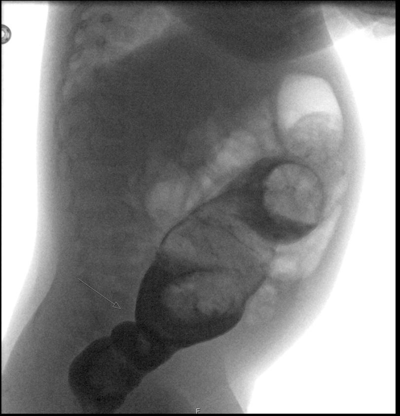 Hirschprung Disease - Imaging Contrast enema newborn, 2w Radiological diagnosis Identification of the transition zone Small catheter placed close