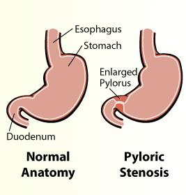 Hypertrophic pyloric stenosis Pathophysiology Idiopathic thickening of gastric pyloric muscle Partial or complete pyloric obstruction Epidemiology 3/1000 live births 4x more common in boys Clinical