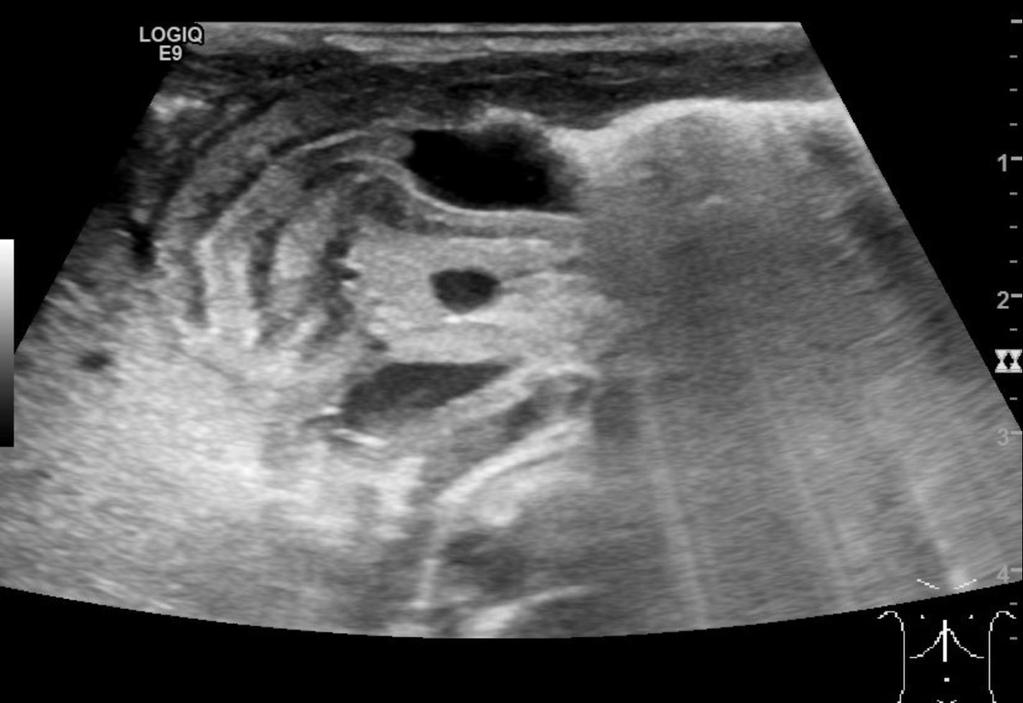 Hypertrophic pyloric stenosis - imaging «Cervix» sign http://www.ohsu.