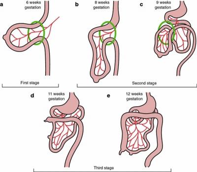 Malrotation ) Failure of the midgut to undergo appropriate rotation and retroperitoneal fixation during early fetal life.