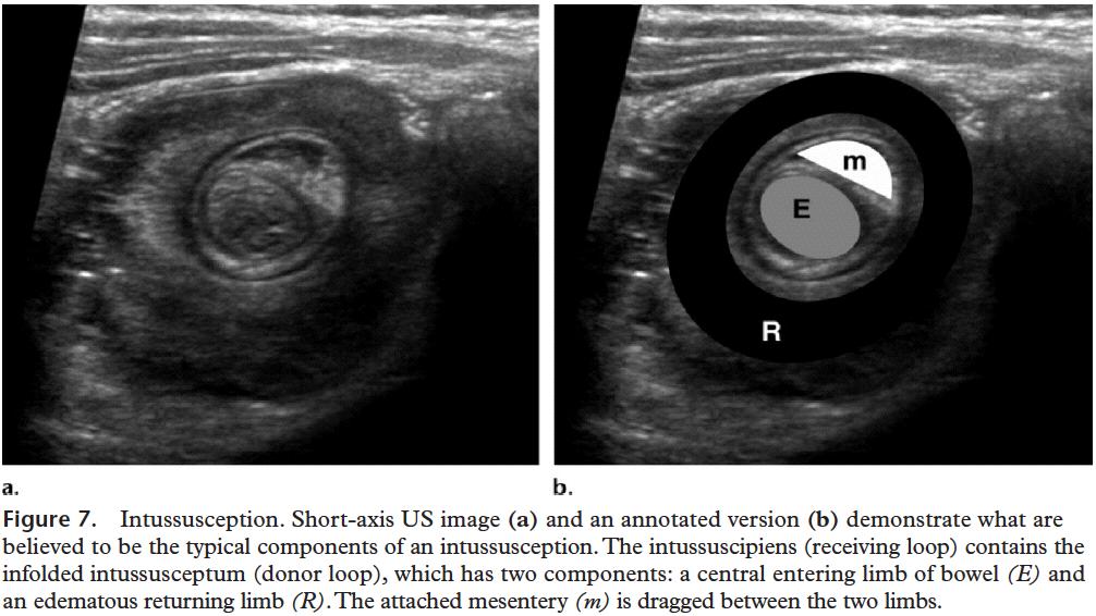 Intussusception - Ultrasound «Emergent Pediatric US: What Every Radiologist Should