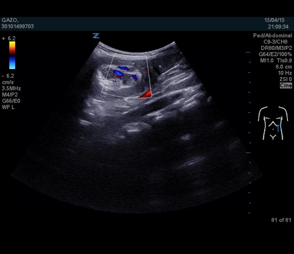 Intussusception - Ultrasound 6 months old boy, long