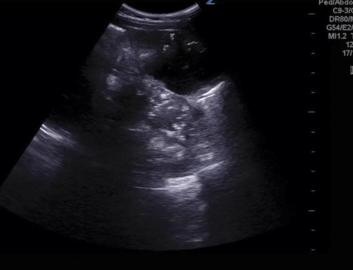 Intussusception -