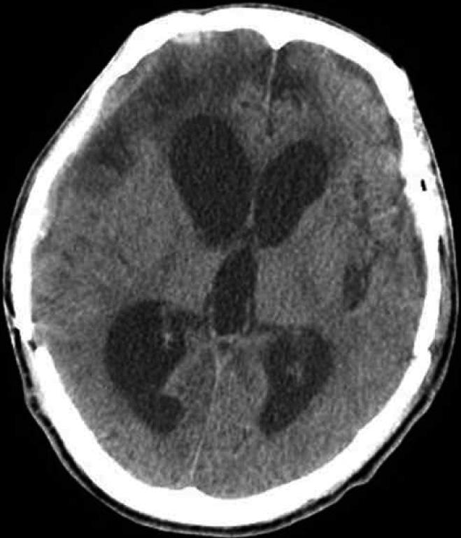 Ventricular enlargement developed from about 2.5 months after trauma. Posttraumatic hydrocephalus was confirmed at 140 days after trauma.