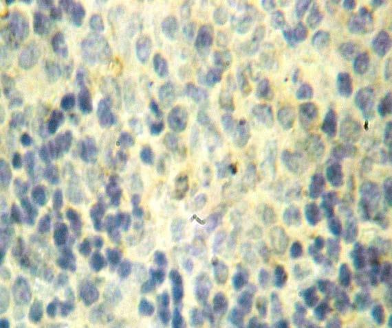 IHC spleen Figure 3: Section of different spleen tissue showing TNF-alpha expression (cytoplasmic staining) of Macrophage.Score 3, strong Intensity.(IHC).