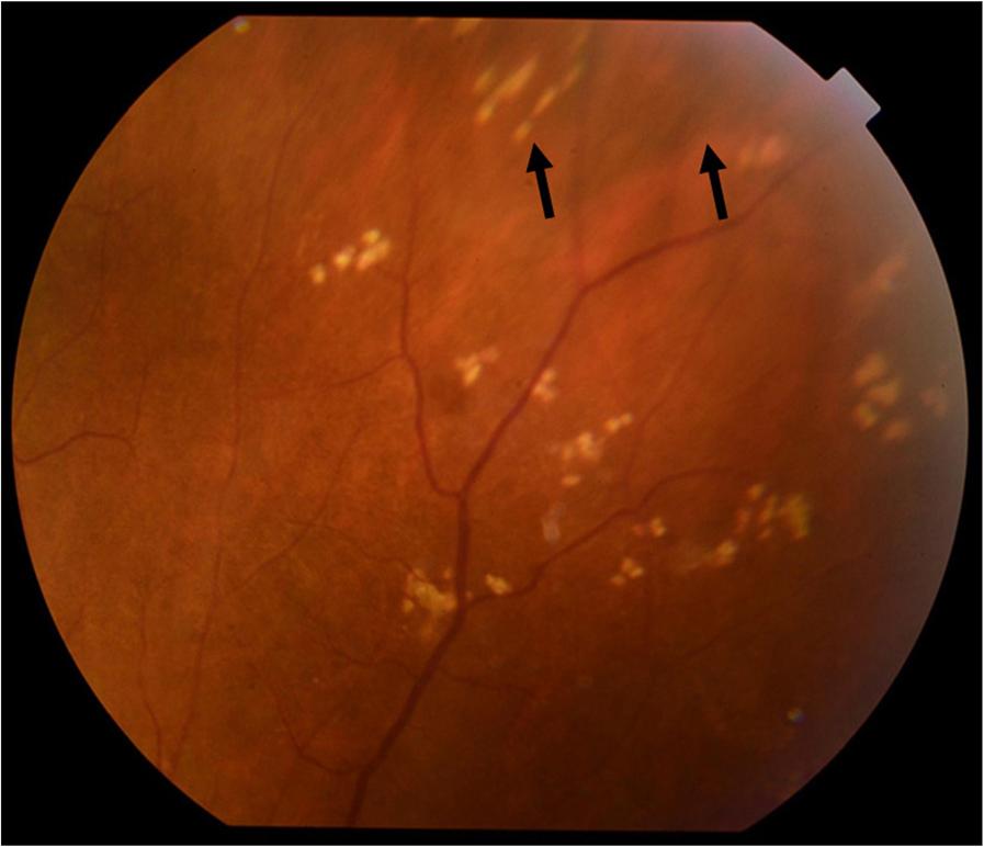 Some studies have reported cases of infectious inflammation, such as tuberculosis or syphilis, caused by nodular infectious uveitis [9, 10]. Biswas et al.
